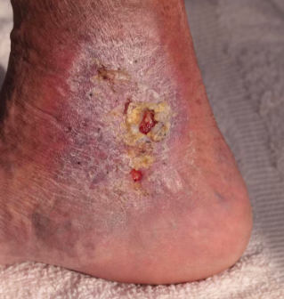 Manejo Avanzado del Pie Diabético